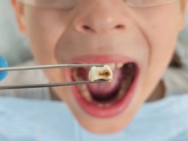 Best Knocked-Out Tooth (Avulsed Tooth) Treatment in Las Vegas, NM